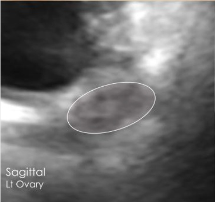 Left ovary sagittal view ultrasound